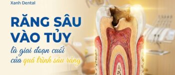 Dấu hiệu răng sâu vào tủy là gì? Có cần lấy tủy hay nhổ răng?