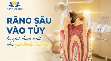 Dấu hiệu răng sâu vào tủy là gì? Có cần lấy tủy hay nhổ răng?