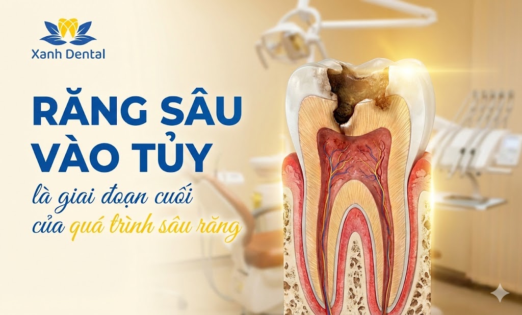 Dấu hiệu răng sâu vào tủy là gì? Có cần lấy tủy hay nhổ răng?